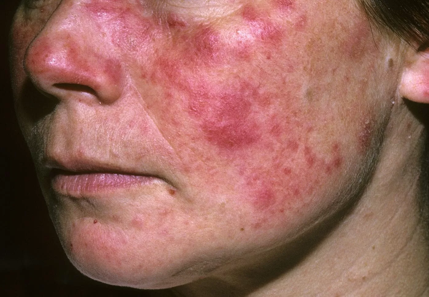 Lupus: Symptoms, Types, Treatment, and Life Expectancy 1 lupus