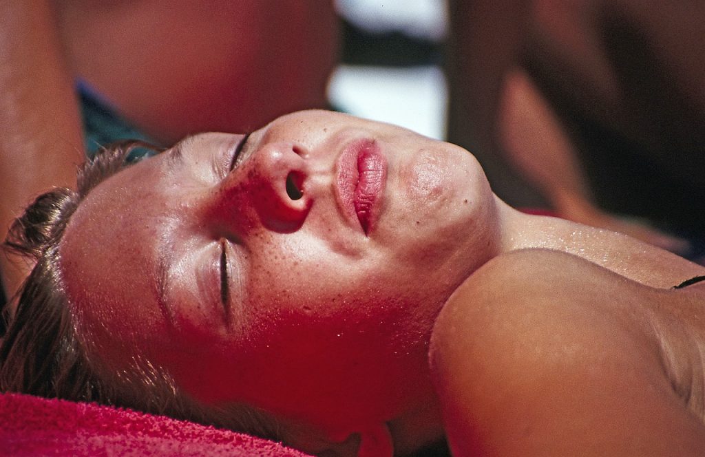 How to get rid of a sunburn’s peeling skin