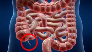 Why Do We Have an Appendix? Examining the Historical and Potential Functions of the Human Appendix