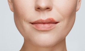 Cold Sores Explained: Viral Causes and Triggers of Herpes Outbreaks