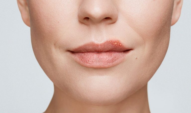 Why Do We Get Cold Sores? Understanding the Viral Causes and Triggers of Herpes Simplex Virus Outbreaks