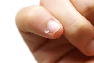 Why Do We Get Hangnails? Exploring the Causes and Prevention of Hangnails
