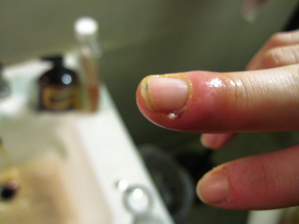 How do you treat a cuticle inflammation or paronychium ?