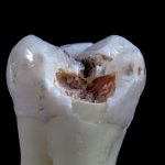 12 Foods That Help Prevent Tooth Decay
