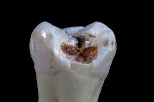 12 Foods That Help Prevent Tooth Decay