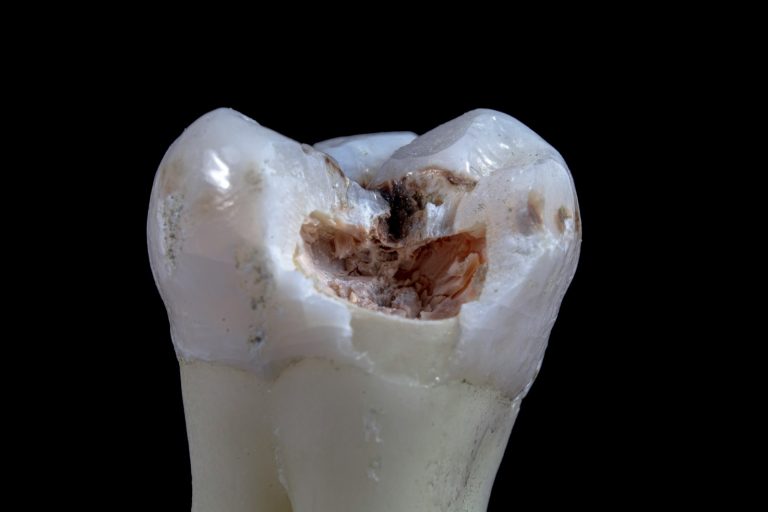 12 Foods That Help Prevent Tooth Decay