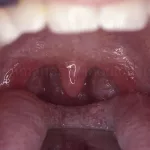 Why Do We Have Tonsils? Examining the Function and Role of Tonsils in the Immune System