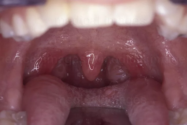 Why Do We Have Tonsils? Examining the Function and Role of Tonsils in the Immune System