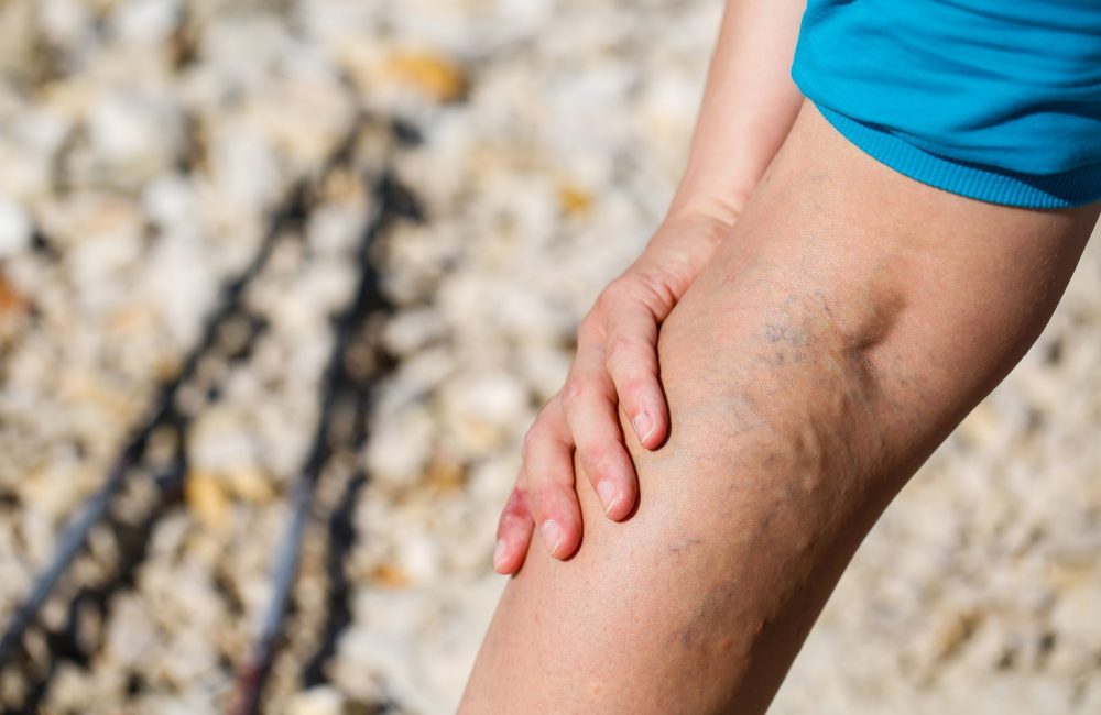 varicose veins