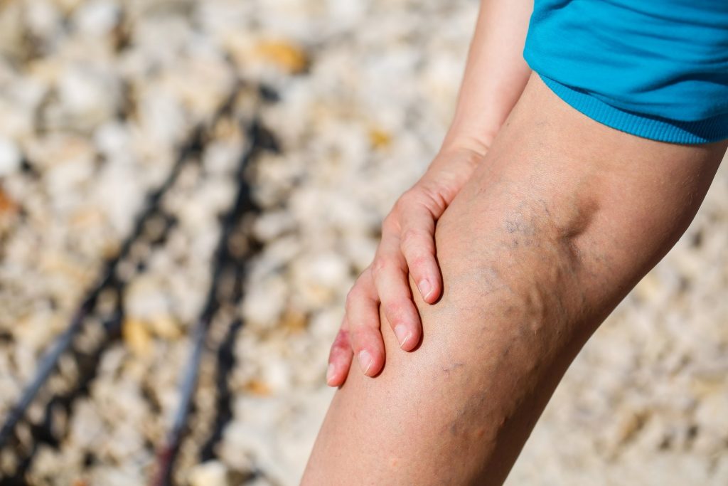 Causes and Treatments for Varicose Veins: What You Need to Know 1 Causes and Treatments for Varicose Veins: What You Need to Know