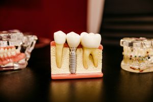 What’s the Difference Between a Prosthodontist and an Orthodontist?