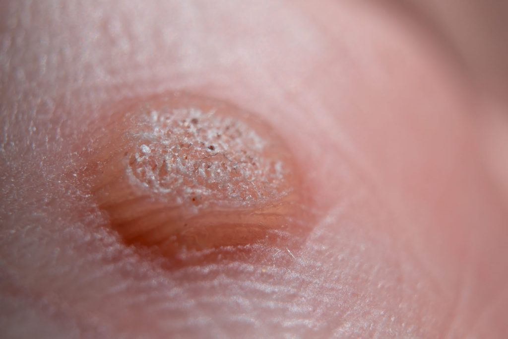 Why Do We Get Warts? Understanding the Causes and Treatments for Warts 1 Why Do We Get Warts? Understanding the Causes and Treatments for Warts