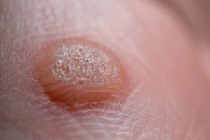 Why Do We Get Warts? Understanding the Causes and Treatments for Warts