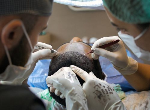 hair transplant, treatment, surgery