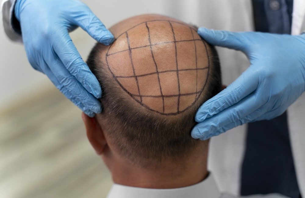 hair, hair care, hair transplant