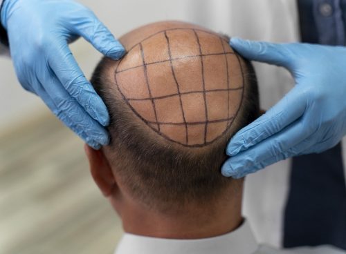 hair, hair care, hair transplant