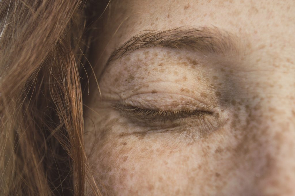 Genetic and Environmental Secrets Behind Freckles: Why They Form on Your Skin