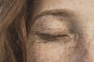 Genetic and Environmental Secrets Behind Freckles: Why They Form on Your Skin