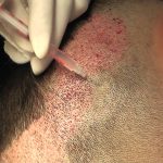 12 post-operative care tips for optimal growth after a hair transplant
