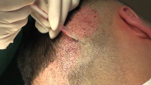 12 Things to Expect During the Hair Transplant Recovery Process