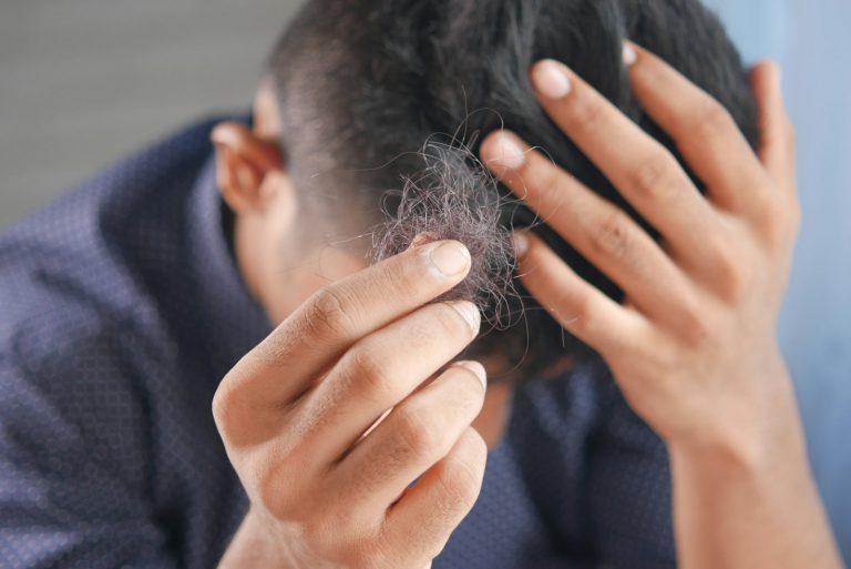 12 Common Causes of Hair Loss in Men and Women