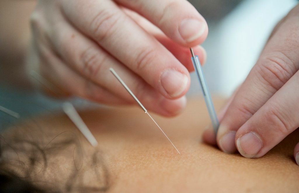 Pros and Cons of Acupuncture for Chronic Pain Relief 1 Pros and Cons of Acupuncture for Chronic Pain Relief