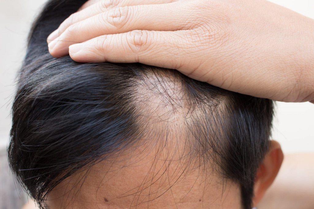 10 Lifestyle Changes to Enhance Hair Growth After a Transplant 1 10 Lifestyle Changes to Enhance Hair Growth After a Transplant