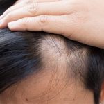10 Warning Signs of a Failing Hair Transplant