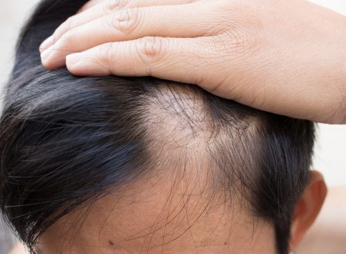 signs of alopecia