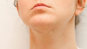 Why Do Some Women Grow a Beard?