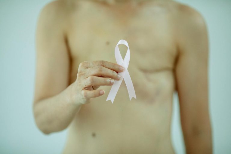 Mastectomy: Understanding the Types, Reasons, and Emotional Impact of Breast Removal Surgery