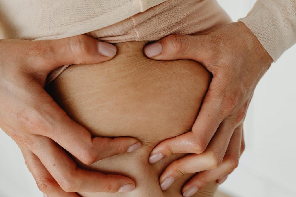 How to Get Rid of Stretch Marks… Or Prevent Them