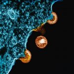 HIV/AIDS: causes, symptoms, prevention, and treatment