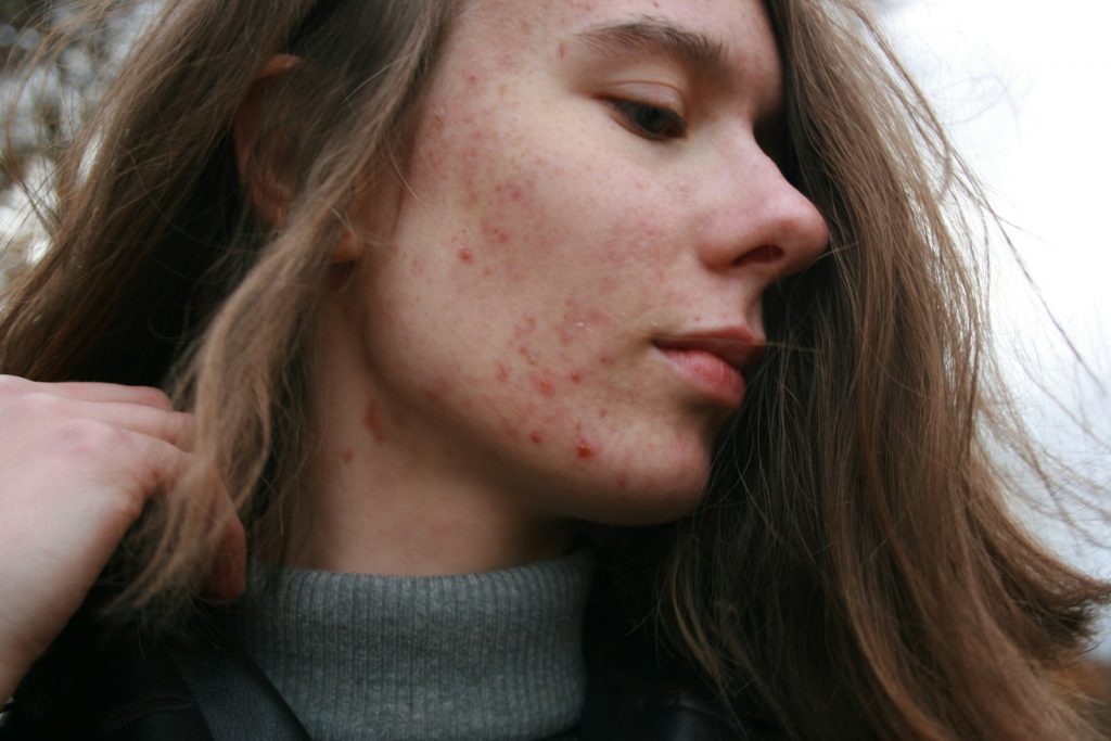7 Key Acne Facts: Debunking Myths & Effective Treatments