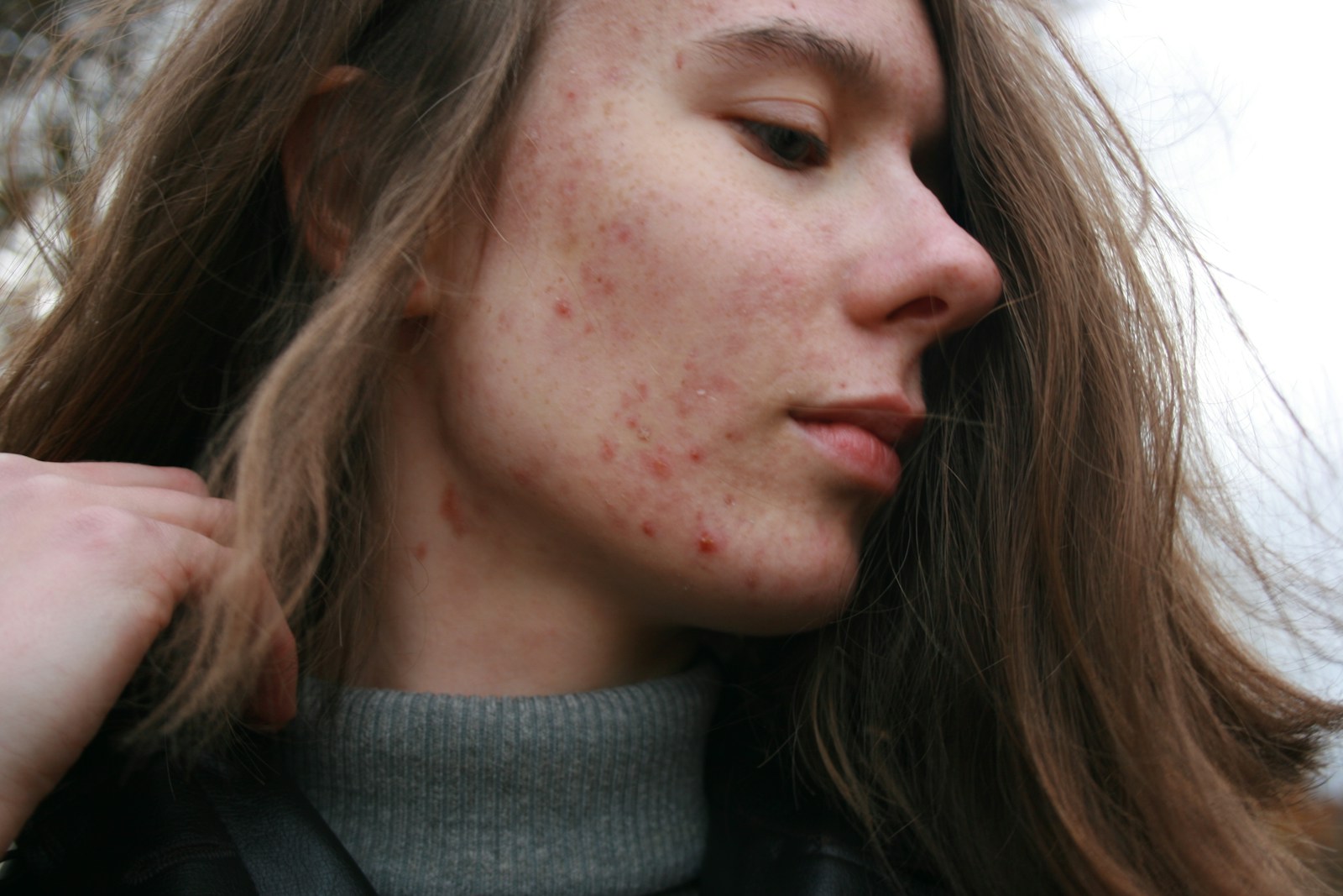 7 Key Acne Facts: Debunking Myths & Effective Treatments 1 a woman with a substance on her face