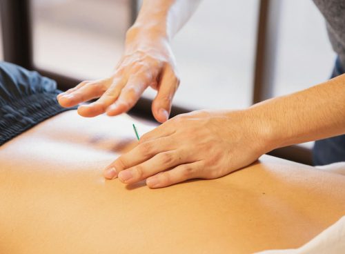 Crop anonymous male doctor putting needles on back during acupuncture therapy session in rehabilitation salon