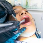 What Are Wisdom Teeth and Why You Should Get Them Removed
