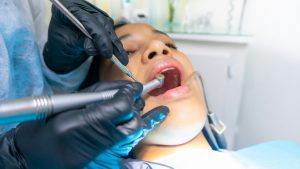 What Are Wisdom Teeth and Why You Should Get Them Removed