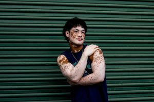 11 Natural Remedies Against Vitiligo
