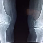 13 Best Foods for Bone Density and Strength