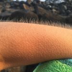 Why Do Goosebumps Happen? Unraveling the Science and Evolution Behind Piloerection