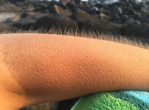 goosebumps