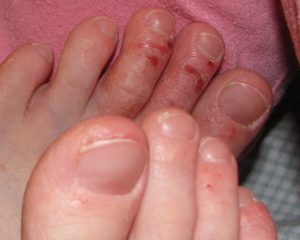 15 Best Foods to Soothe Eczema