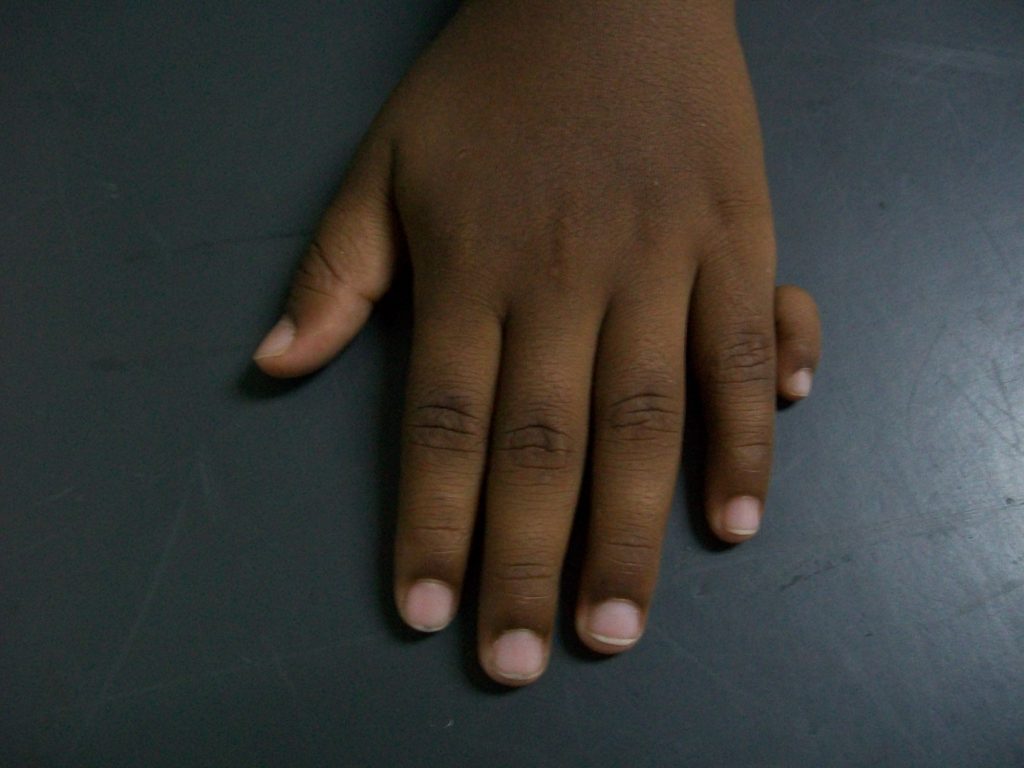 Why Do Some People Have Six Fingers? Understanding Polydactyly from a Scientific Perspective 1 Why Do Some People Have Six Fingers? Understanding Polydactyly from a Scientific Perspective
