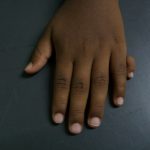 Why Do Some People Have Six Fingers? Understanding Polydactyly from a Scientific Perspective