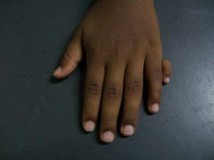 Why Do Some People Have Six Fingers? Understanding Polydactyly from a Scientific Perspective