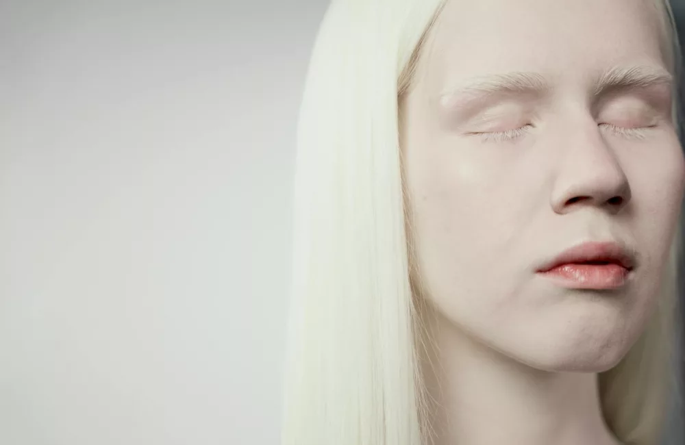 Albinism