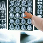 Split Brains: What Happens When the Brain’s Hemispheres Stop Communicating?