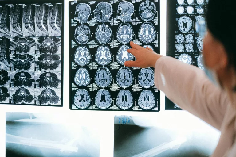 Split Brains: What Happens When the Brain’s Hemispheres Stop Communicating?