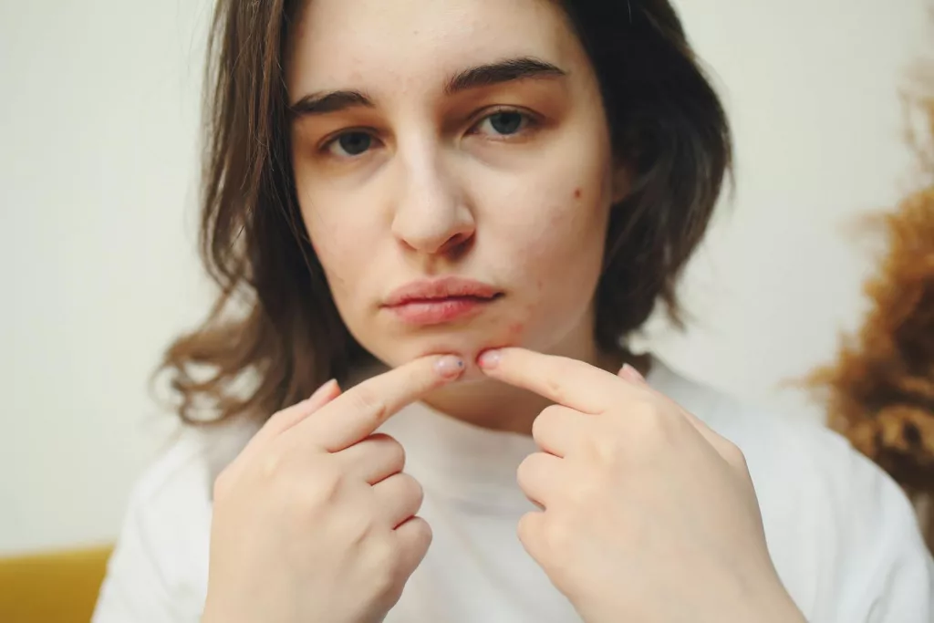 Why Teenagers Get So Much Acne: Understanding the Causes of Adolescent Breakouts